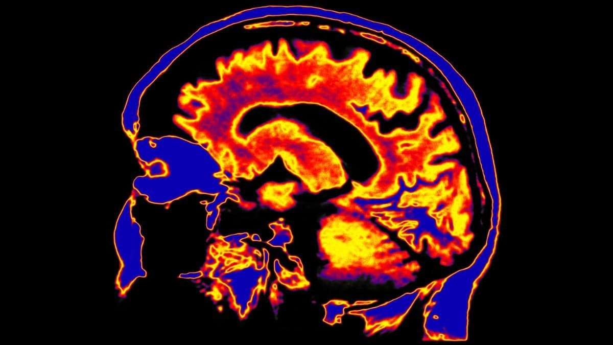 Scientists identify brain waste system linked to chronic fatigue syndrome
